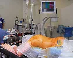 مقارنة بين الجراحة المفتوحة والمناظير