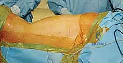 مضاعفات الجنف وتأثيره على الأعضاء الداخلية