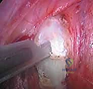 صورة توضيحية لـ جراحة تحرير ودمج الجنف الأمامي بالمنظار الصدري: دليل شامل للمرضى