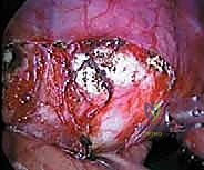 جراحة تحرير ودمج الجنف الأمامي بالمنظار الصدري: دليل شامل للمرضى