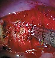 صورة طبية: جراحة تحرير ودمج الجنف الأمامي بالمنظار الصدري: دليل شامل للمرضى