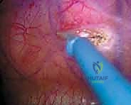 صورة توضيحية لـ جراحة تحرير ودمج الجنف الأمامي بالمنظار الصدري: دليل شامل للمرضى