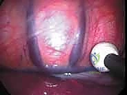 تطور جراحات الجنف إلى التدخل المحدود