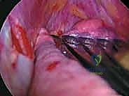 التخدير والأنبوب المزدوج