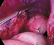 صورة طبية: جراحة تحرير ودمج الجنف الأمامي بالمنظار الصدري: دليل شامل للمرضى