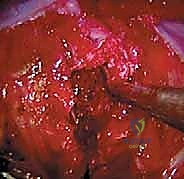 صورة توضيحية لـ جراحة تحرير ودمج الجنف الأمامي بالمنظار الصدري: دليل شامل للمرضى