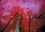 صورة توضيحية لـ جراحة تحرير ودمج الجنف الأمامي بالمنظار الصدري: دليل شامل للمرضى