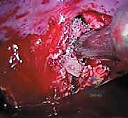 Illustration of release and fusion - Dr. Mohammed Hutaif