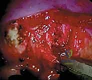 صورة توضيحية لـ جراحة تحرير ودمج الجنف الأمامي بالمنظار الصدري: دليل شامل للمرضى