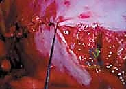 صورة توضيحية لـ جراحة تحرير ودمج الجنف الأمامي بالمنظار الصدري: دليل شامل للمرضى