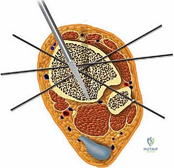 صورة طبية: تشتيت مفصل الكاحل: حل بيولوجي متقدم لتجديد الغضروف وتخفيف الألم مع الأستاذ الدكتور محمد هطيف