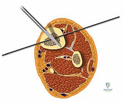 صورة توضيحية لـ تشتيت مفصل الكاحل: حل بيولوجي متقدم لتجديد الغضروف وتخفيف الألم مع الأستاذ الدكتور محمد هطيف