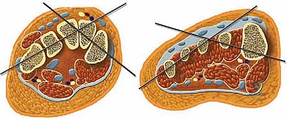 أشعة سينية توضح اتساع مساحة المفصل بعد العلاج
