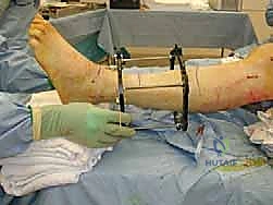 ميكانيكية تشتيت مفصل الكاحل