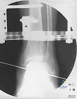 تمارين العلاج الطبيعي للقدم