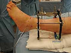 صورة توضيحية لـ تشتيت مفصل الكاحل: حل بيولوجي متقدم لتجديد الغضروف وتخفيف الألم مع الأستاذ الدكتور محمد هطيف