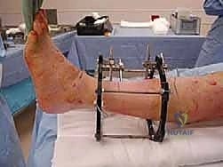 تآكل الغضروف في الكاحل