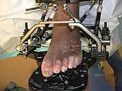 صورة توضيحية لـ تشتيت مفصل الكاحل: حل بيولوجي متقدم لتجديد الغضروف وتخفيف الألم مع الأستاذ الدكتور محمد هطيف