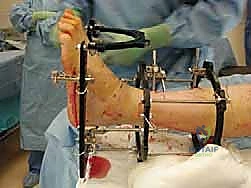 صورة توضيحية لـ تشتيت مفصل الكاحل: حل بيولوجي متقدم لتجديد الغضروف وتخفيف الألم مع الأستاذ الدكتور محمد هطيف