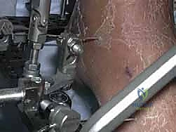 صورة توضيحية لـ تشتيت مفصل الكاحل: حل بيولوجي متقدم لتجديد الغضروف وتخفيف الألم مع الأستاذ الدكتور محمد هطيف