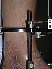 العناية بمواقع الأسلاك المعدنية