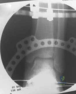 صورة توضيحية لـ تشتيت مفصل الكاحل: حل بيولوجي متقدم لتجديد الغضروف وتخفيف الألم مع الأستاذ الدكتور محمد هطيف