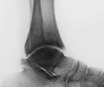 تحميل الوزن والمشي بالإطار