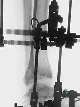 المريض بعد العملية بالإطار الخارجي