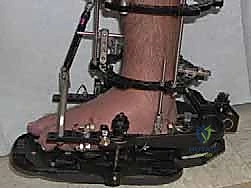 صورة توضيحية لـ تشتيت مفصل الكاحل: حل بيولوجي متقدم لتجديد الغضروف وتخفيف الألم مع الأستاذ الدكتور محمد هطيف