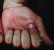 صورة توضيحية لـ تمزق أوتار اليد والمعصم الروماتويدي: دليل شامل للعلاج والتعافي مع الأستاذ الدكتور محمد هطيف في صنعاء