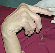 صورة توضيحية لـ تمزق أوتار اليد والمعصم الروماتويدي: دليل شامل للعلاج والتعافي مع الأستاذ الدكتور محمد هطيف في صنعاء