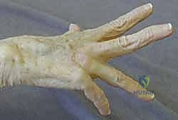 تأثير الالتهاب الروماتويدي على الأوتار