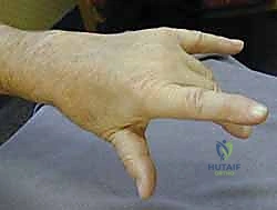 الدكتور محمد هطيف أثناء الجراحة الدقيقة