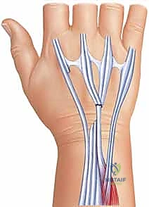 التآكل الميكانيكي للأوتار