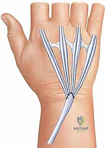 خياطة الأوتار بتقنيات الجراحة الدقيقة