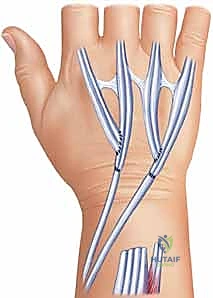 صورة توضيحية لـ تمزق أوتار اليد والمعصم الروماتويدي: دليل شامل للعلاج والتعافي مع الأستاذ الدكتور محمد هطيف في صنعاء