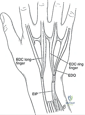 سقوط الأصابع نتيجة تمزق الأوتار
