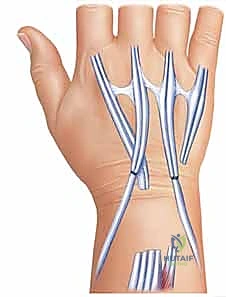 التخطيط الجراحي لنقل الأوتار