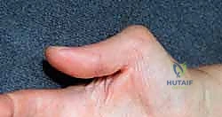 استئصال الغشاء الزليلي الملتهب