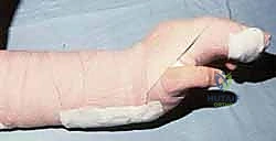 العلاج الطبيعي وتأهيل اليد