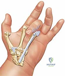 حركة الأوتار الطبيعية