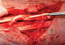 تمزق أوتار اليد والمعصم الروماتويدي: دليل شامل للعلاج والتعافي مع الأستاذ الدكتور محمد هطيف في صنعاء