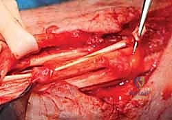 تجهيز الوتر الناقل