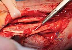 تورم المعصم الروماتويدي