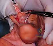 وضع الجبيرة بعد العملية