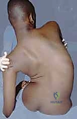 صورة توضح التواء العمود الفقري وتأثيره