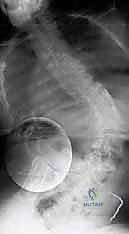 تأثير الجنف على الأعصاب والحوض