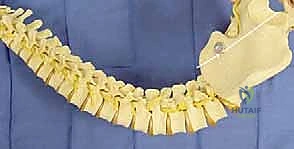 صورة توضيحية لـ جراحة الجنف العصبي العضلي بقضيب الوحدة: حل شامل لتحسين جودة الحياة للأطفال مع الأستاذ الدكتور محمد هطيف في صنعاء