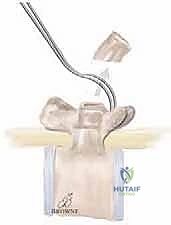 الشق الجراحي والوصول للفقرات