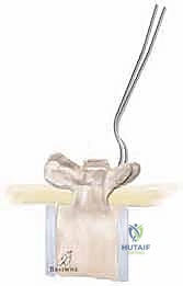 صورة توضيحية لـ جراحة الجنف العصبي العضلي بقضيب الوحدة